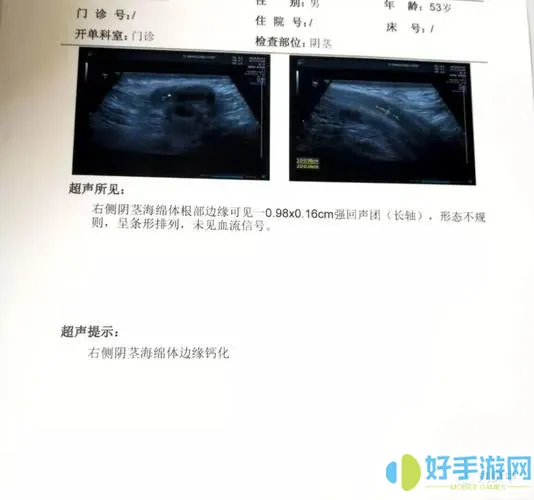 海绵体钙化能治愈吗