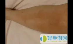 1400元一针的荨麻疹特效针