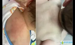 宝宝头上长痱子了怎么快速消除